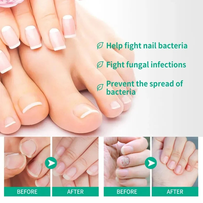 Herbal Nail Fungus Treatment Gel 30ml Short Eye Catching Title for Foot Care Protection Skin Repair Cream Nail Polish Repair Products