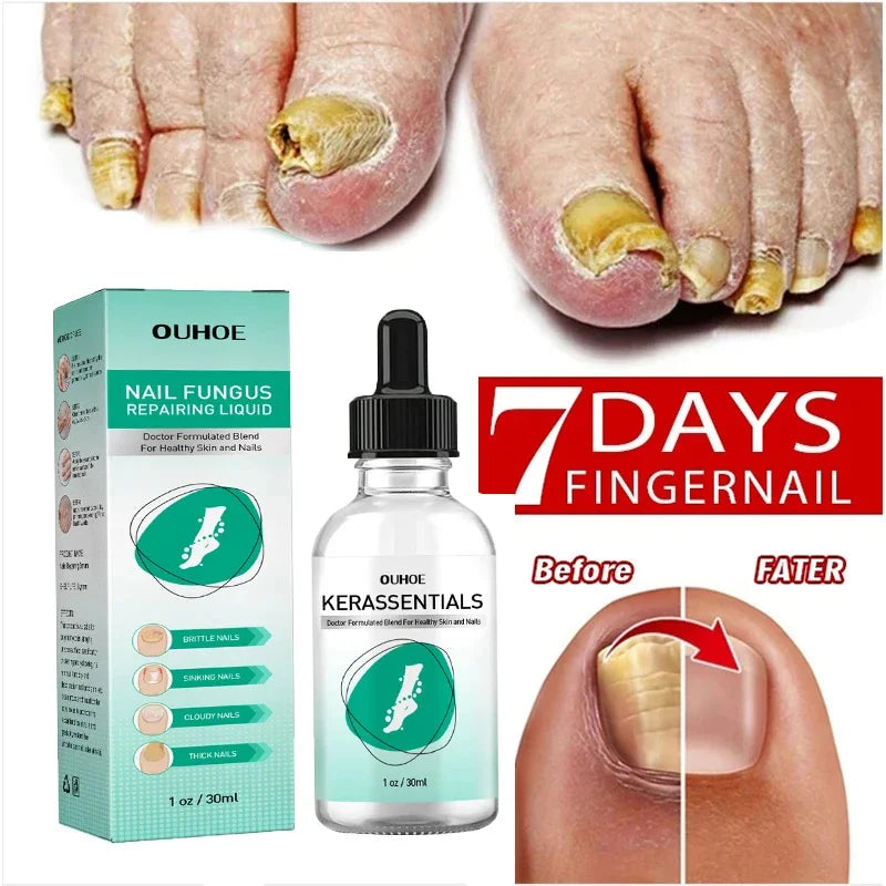 Herbal Nail Fungus Treatment Gel 30ml Short Eye Catching Title for Foot Care Protection Skin Repair Cream Nail Polish Repair Products