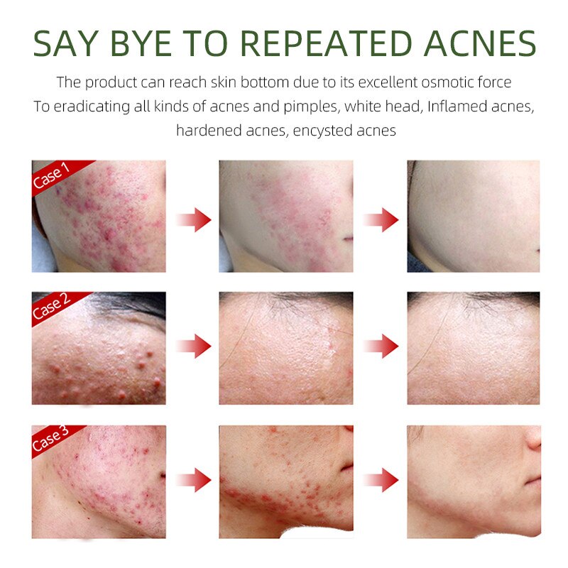 Herbal Acne Removal Face Cream - Executive-Skincare