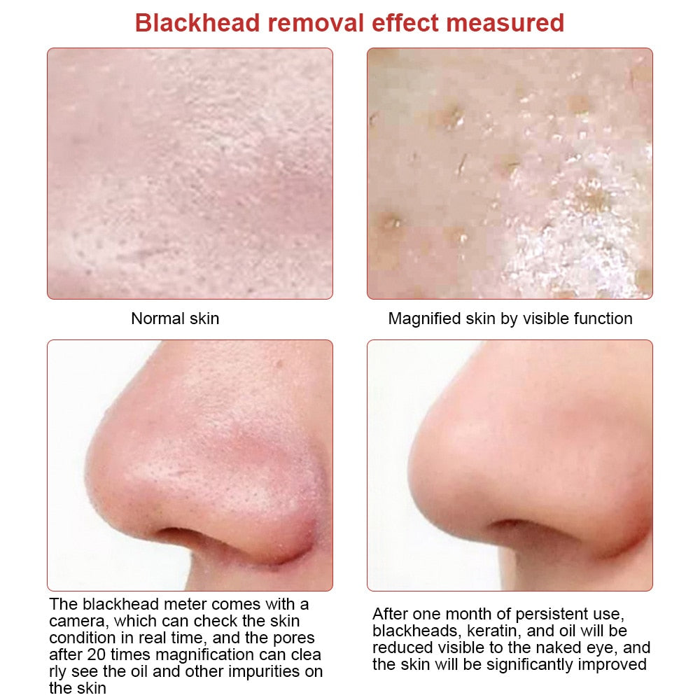 Visible Camera Blackhead Remover Face Deep Nose Cleaner Pore Acne Pimple Removal Vacuum Suction Facial Beauty Clean Skin Tool - Executive-Skincare