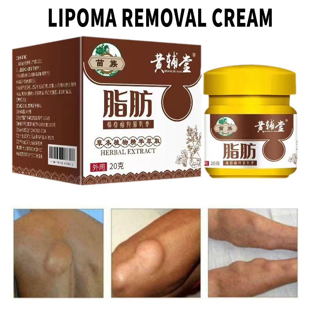 Lipoma Removal Cream 20G Relief Pain Treat Skin Swelling Lipolysis Cellulite Remover Ointment Lipolysis Fat Lump Body Care