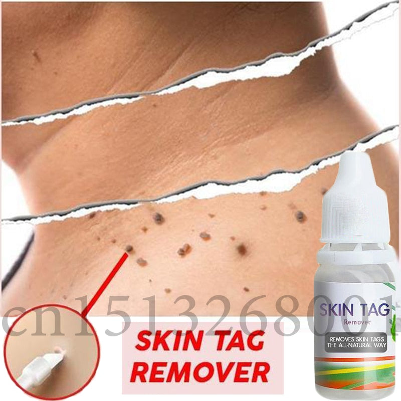 Skin Tag Remover 12 hours Tu kill Medical Tu kill Remover Skin Tag Mole - Executive-Skincare