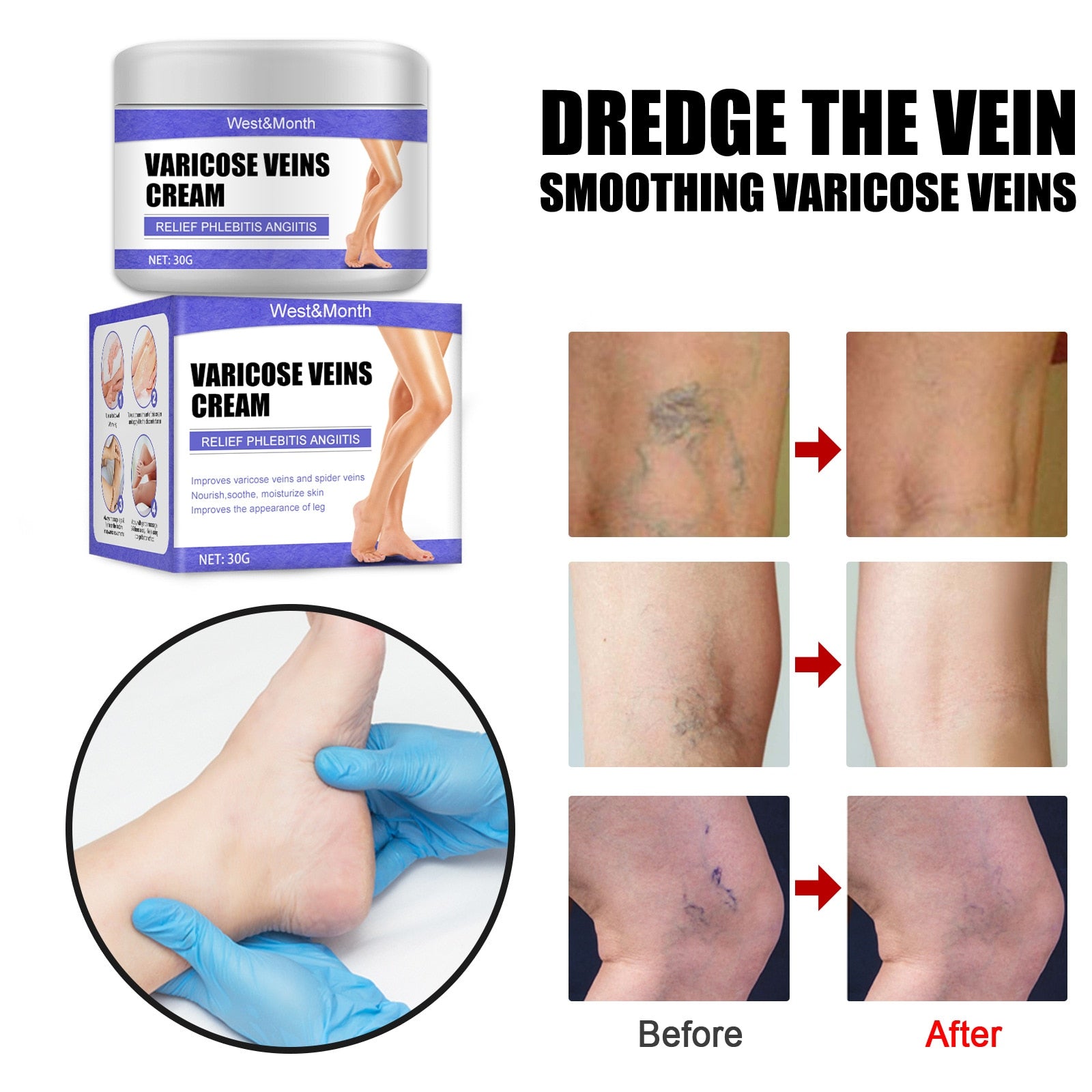 Effective Varicose Veins Relief Cream Relieve Vasculitis Phlebitis Spider Pain Treatment Ointment Medical Plaster Body Care 30g - Executive-Skincare