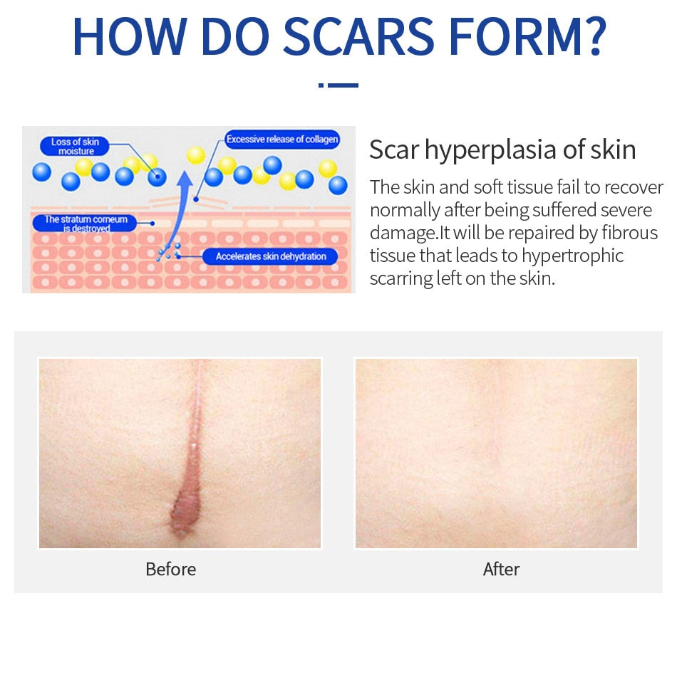 Scar Removal Cream Gel Remove Acne Spots Treatment Stretch Marks Burn Surgical Scar Repair Cream Smoothing Whitening Skin Beauty - Executive Quality Store