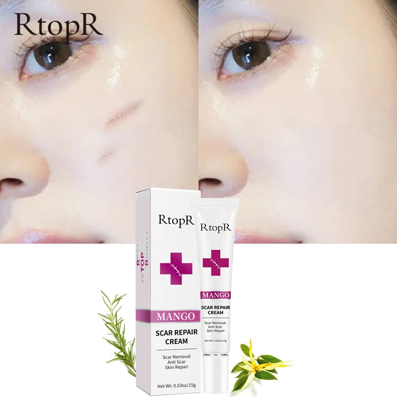 Skin Scar Removal Cream Face Fade Scars Cream Acne Spots Acne Treatment Blackhead Whitening Cream Anti Scar Stretch Marks Beauty - Executive Quality Store