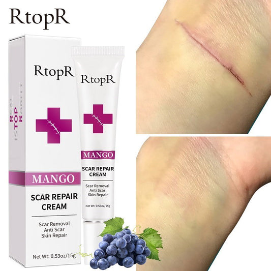 Skin Scar Removal Cream Face Fade Scars Cream Acne Spots Acne Treatment Blackhead Whitening Cream Anti Scar Stretch Marks Beauty - Executive Quality Store