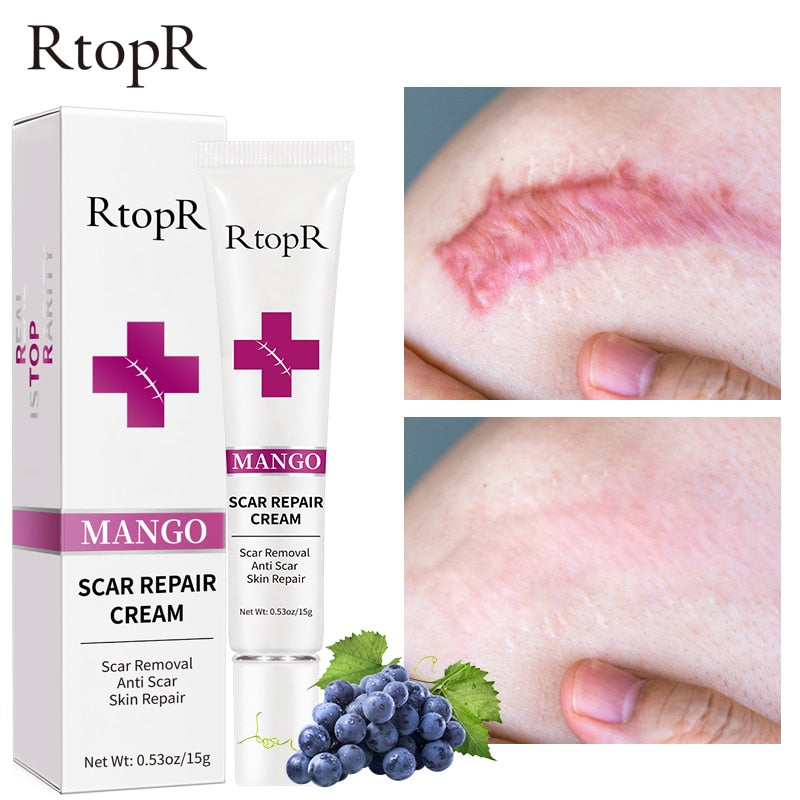 Skin Scar Removal Cream Face Fade Scars Cream Acne Spots Acne Treatment Blackhead Whitening Cream Anti Scar Stretch Marks Beauty - Executive Quality Store