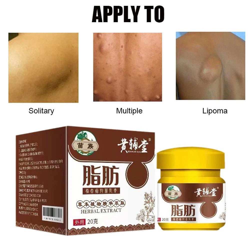 Lipoma Removal Cream 20G Relief Pain Treat Skin Swelling Lipolysis Cellulite Remover Ointment Lipolysis Fat Lump Body Care