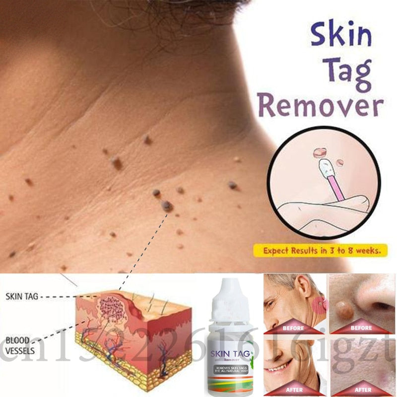 Skin Tag Remover 12 hours Tu kill Medical Tu kill Remover Skin Tag Mole - Executive-Skincare