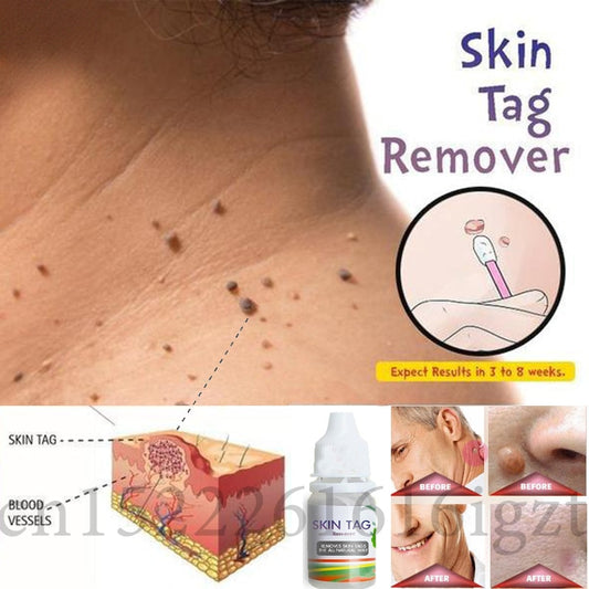 Skin Tag Remover 12 hours Tu kill Medical Tu kill Remover Skin Tag Mole - Executive-Skincare